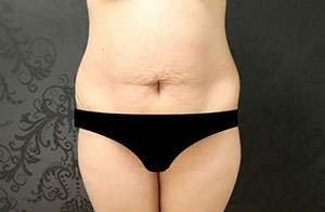 Abdominoplastia Before & After